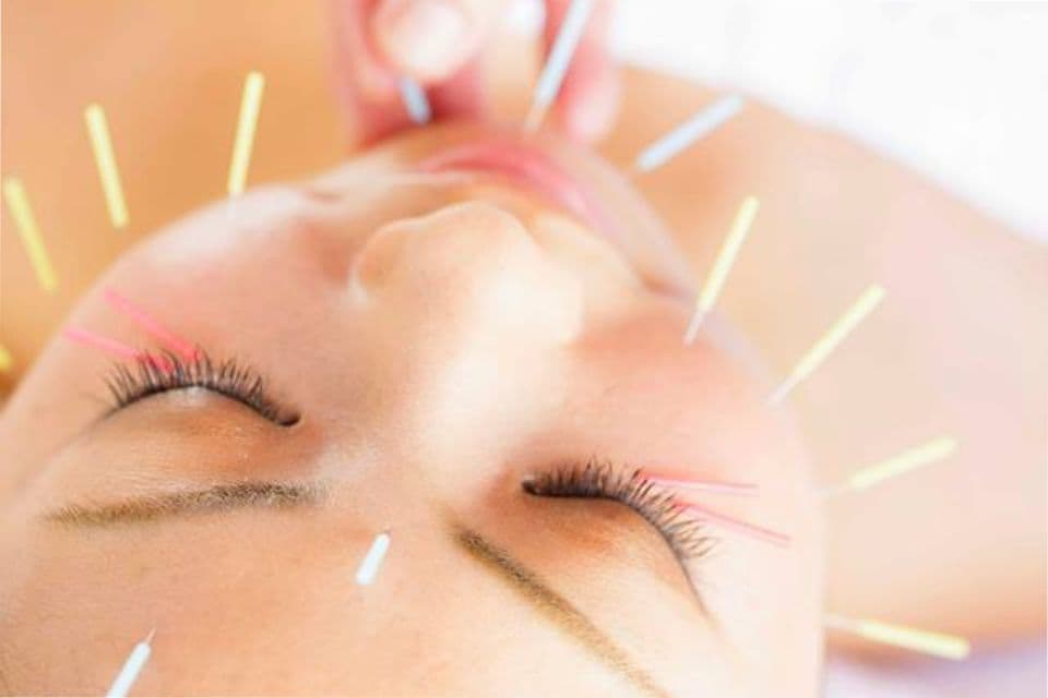 美容鍼とは