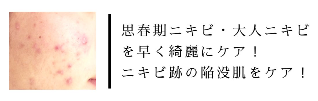 ニキビケア